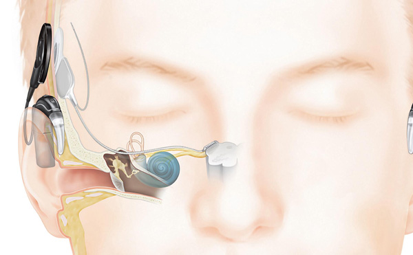 Global Auditory Brainstem Implant Market 2020 to 2024 with Strategic Trends Growth, Revenue: Radiant Insights Inc